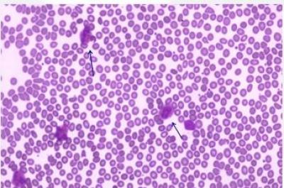 Figure 1 : Full blood picture showed marked eosinophilia (arrows)